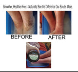 remove dry skin from feet