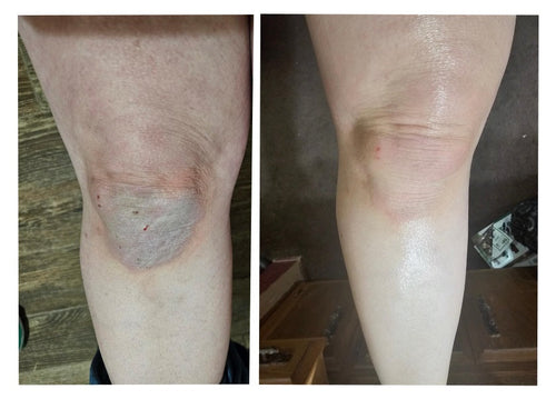 calloused knees before and after using Elly's sugar scrub