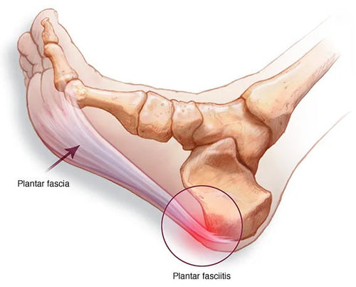 foot with planter-fasciitis