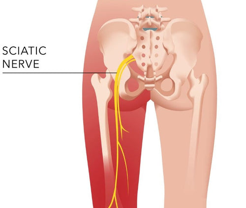 symptoms of sciatica chart