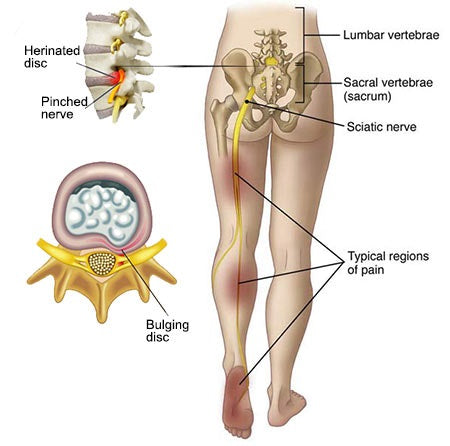 pinpointing sciatica pain chart